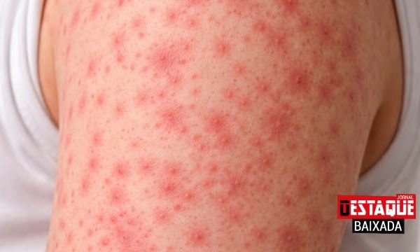 Sarampo: Rio de Janeiro Confirma Caso e Acende Alerta Sanitário