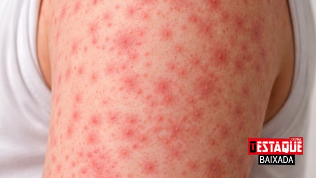 Sarampo: Rio de Janeiro Confirma Caso e Acende Alerta Sanitário